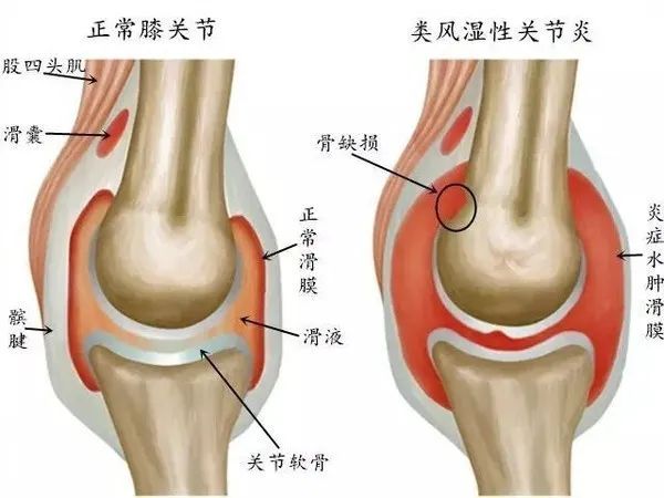 中医定向透药治疗仪对关节炎的治疗.jpg